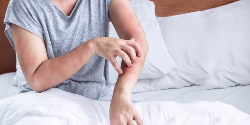 Bed bug bites on skin — signs of infestation