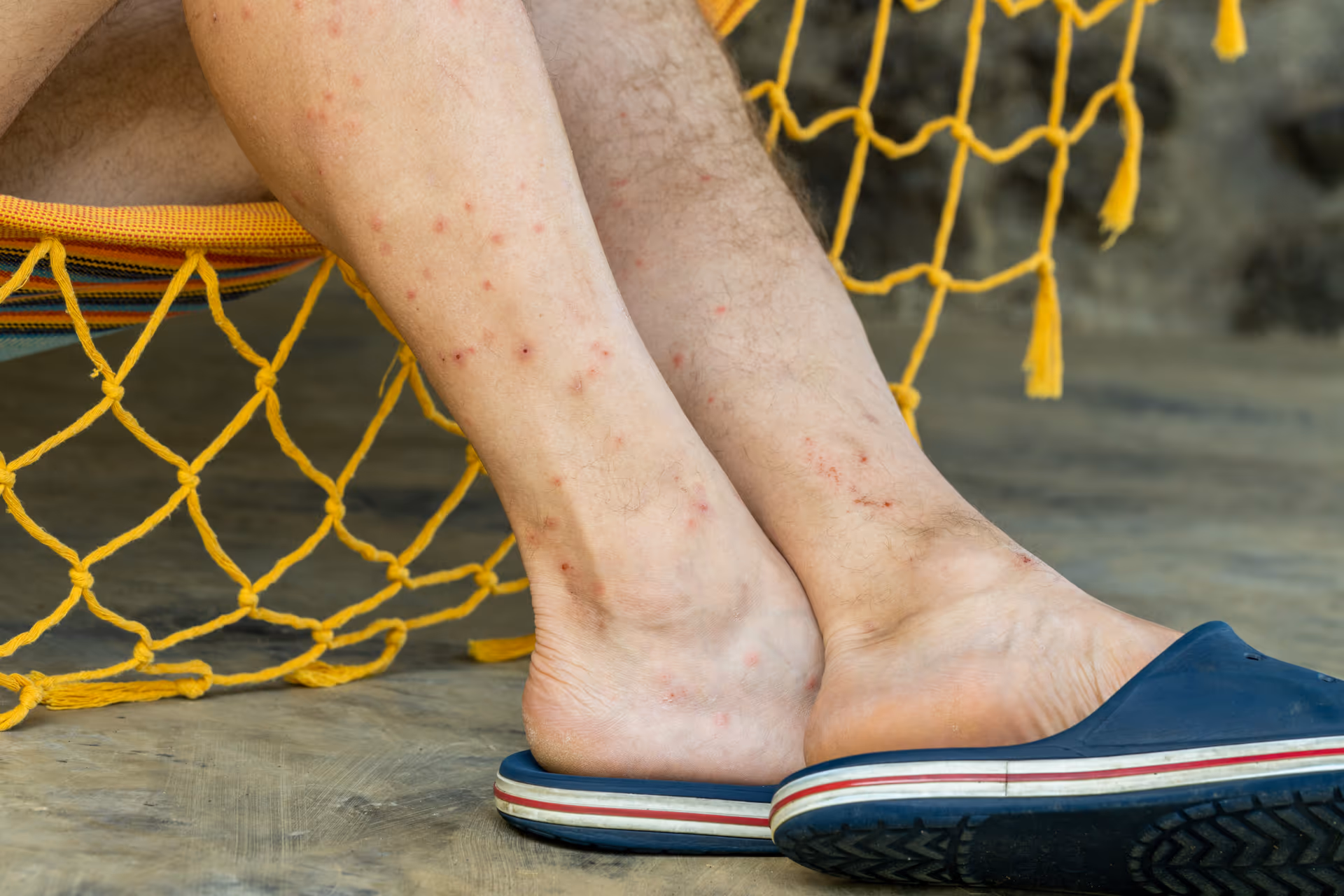 Flea bites on human ankles and legs — Pesticon flea control Vancouver