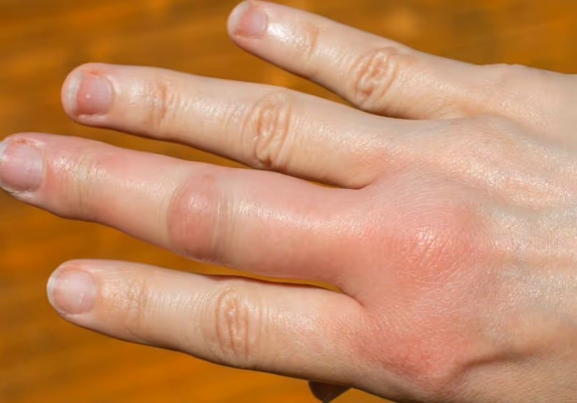 Bee stings — what to do for fast relief