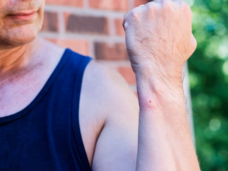 Wasp sting on arm swelling Vancouver wasp control Pesticon
